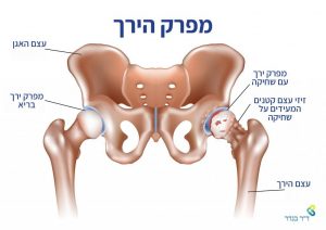 שחיקת סחוס במפרק הירך