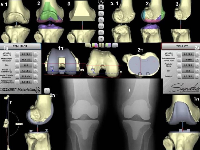 החלפת מפרק ברך – בהנחיית מחשב (רובוט) ומותאמת אישית