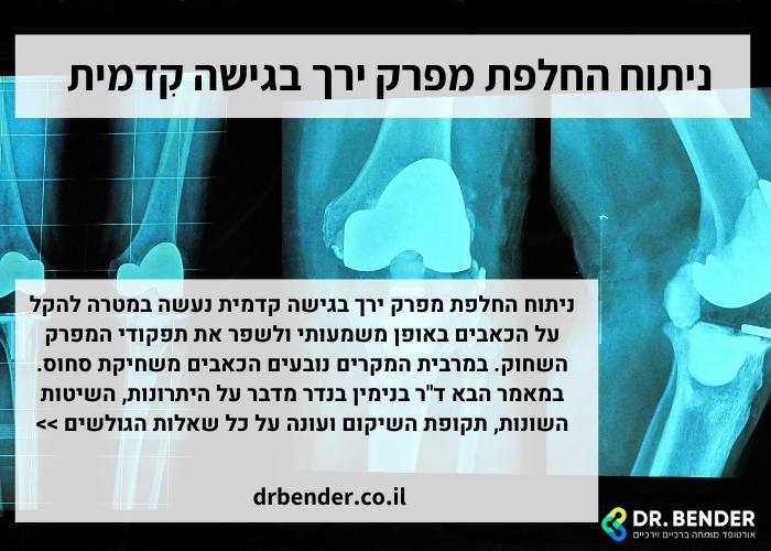 ניתוח החלפת מפרק ירך בגישה קִדמית